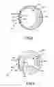 Fig. 07 - Ablation catheter with fluid distribution structures