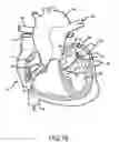 Fig. 13 - Ablation catheter with fluid distribution structures