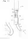 Fig. 12 - Single catheter mitral valve repair device and method for use
