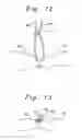 Fig. 13 - Single catheter mitral valve repair device and method for use