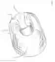 Fig. 04 - Apparatus and methods for intravascular embolic protection