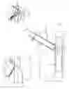 Fig. 11 - Interventional medical closure device
