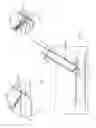 Fig. 13 - Interventional medical closure device
