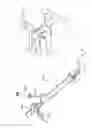 Fig. 64 - Interventional medical closure device