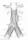 Fig. 02 - Self expanding bifurcated endovascular prosthesis