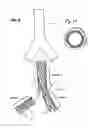 Fig. 03 - Self expanding bifurcated endovascular prosthesis