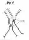 Fig. 05 - Self expanding bifurcated endovascular prosthesis