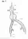 Fig. 08 - Self expanding bifurcated endovascular prosthesis