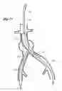 Fig. 10 - Self expanding bifurcated endovascular prosthesis