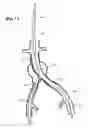 Fig. 11 - Self expanding bifurcated endovascular prosthesis