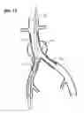 Fig. 12 - Self expanding bifurcated endovascular prosthesis
