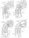 Fig. 09 - Endovascular prosthesis