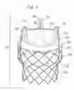 Fig. 03 - Rapid deployment prosthetic heart valve