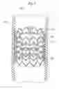 Fig. 08 - Rapid deployment prosthetic heart valve