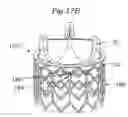 Fig. 23 - Rapid deployment prosthetic heart valve