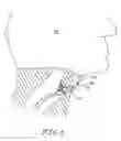 Fig. 02 - Voice Prosthesis Device