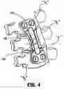 Fig. 04 - Method of repairing a bone joint