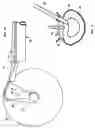 Fig. 10 - Mechanical apparatus and method for artificial disc replacement