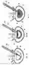 Fig. 11 - Mechanical apparatus and method for artificial disc replacement