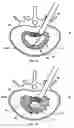 Fig. 14 - Mechanical apparatus and method for artificial disc replacement