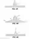 Fig. 03 - Spinal disc annulus reconstruction method and deformable spinal disc annulus stent