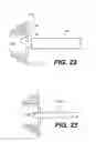 Fig. 16 - Spinal disc annulus reconstruction method and deformable spinal disc annulus stent