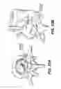 Fig. 22 - Spinal disc annulus reconstruction method and deformable spinal disc annulus stent