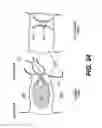 Fig. 23 - Spinal disc annulus reconstruction method and deformable spinal disc annulus stent