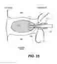 Fig. 24 - Spinal disc annulus reconstruction method and deformable spinal disc annulus stent