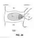 Fig. 25 - Spinal disc annulus reconstruction method and deformable spinal disc annulus stent