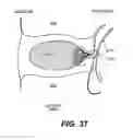 Fig. 26 - Spinal disc annulus reconstruction method and deformable spinal disc annulus stent