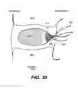 Fig. 28 - Spinal disc annulus reconstruction method and deformable spinal disc annulus stent