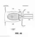 Fig. 31 - Spinal disc annulus reconstruction method and deformable spinal disc annulus stent