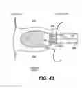 Fig. 32 - Spinal disc annulus reconstruction method and deformable spinal disc annulus stent