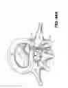 Fig. 33 - Spinal disc annulus reconstruction method and deformable spinal disc annulus stent