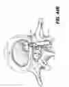 Fig. 34 - Spinal disc annulus reconstruction method and deformable spinal disc annulus stent