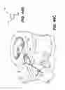 Fig. 35 - Spinal disc annulus reconstruction method and deformable spinal disc annulus stent