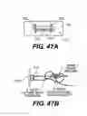 Fig. 45 - Spinal disc annulus reconstruction method and deformable spinal disc annulus stent