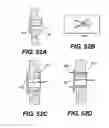 Fig. 55 - Spinal disc annulus reconstruction method and deformable spinal disc annulus stent