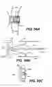 Fig. 61 - Spinal disc annulus reconstruction method and deformable spinal disc annulus stent
