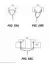 Fig. 63 - Spinal disc annulus reconstruction method and deformable spinal disc annulus stent