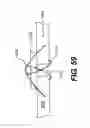 Fig. 64 - Spinal disc annulus reconstruction method and deformable spinal disc annulus stent