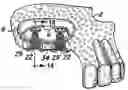 Fig. 01 - Maxillary sinus bone augmentation with resorbable bone pack