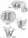 Fig. 04 - Maxillary sinus bone augmentation with resorbable bone pack