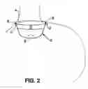 Fig. 03 - Positioning tools and methods for implanting medical devices