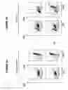 Fig. 03 - Identification of a JAK2 mutation involved in Vaquez Polyglobulia