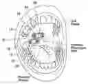 Fig. 01 - Devices, systems, and methods using magnetic force systems in or on tissue in an airway