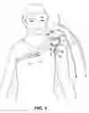 Fig. 02 - Carrying aid device