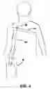 Fig. 05 - Carrying aid device