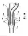 Fig. 18 - End-to-end anastomosis instrument and method for performing same